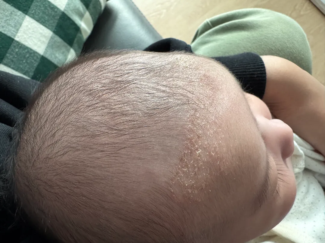 ㅠㅠ이마에 ㅠㅠ이거 병원가야할까요..!