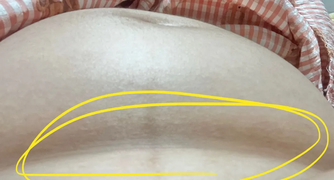 배 아래 주름