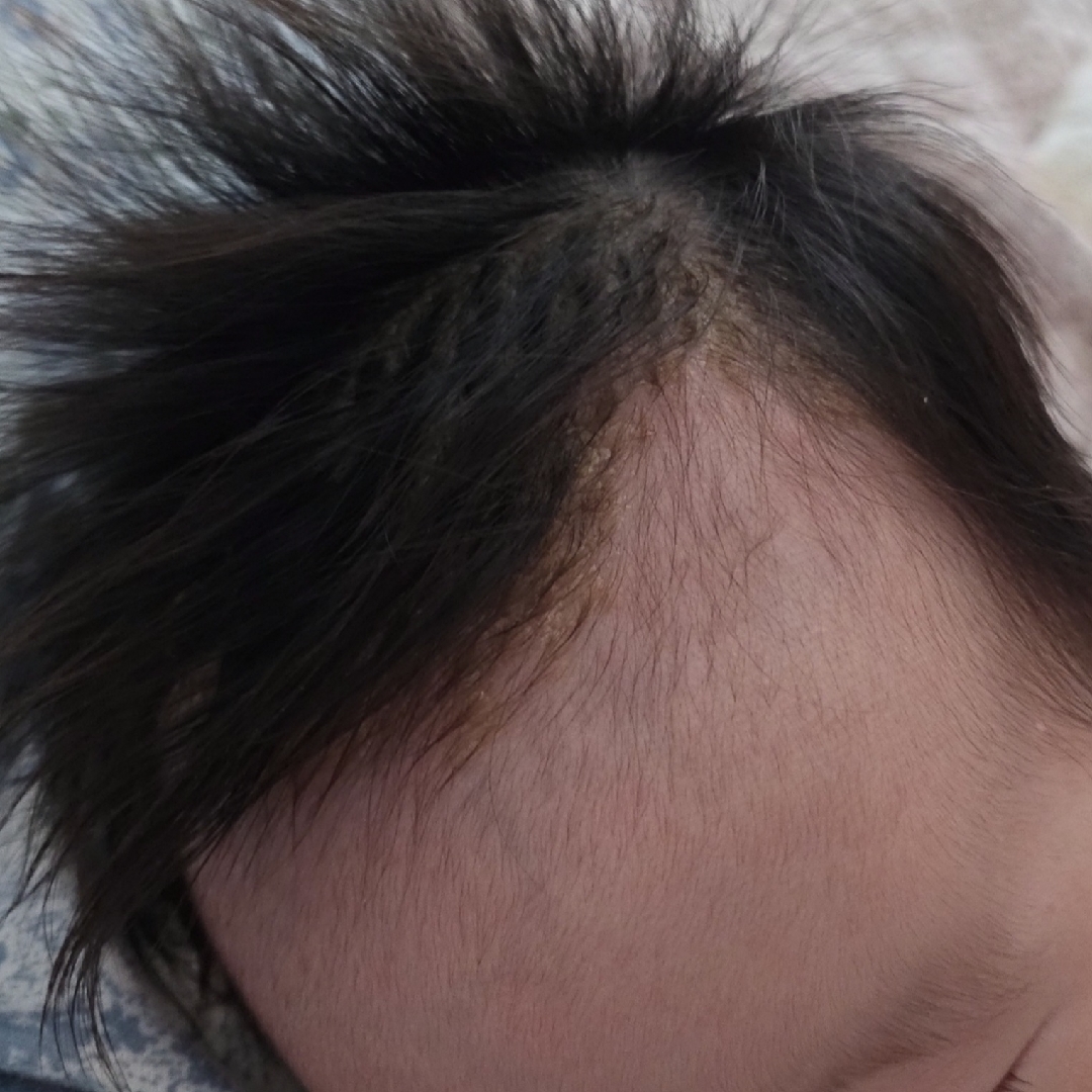 3개월 아기 두피 지루성피부염??