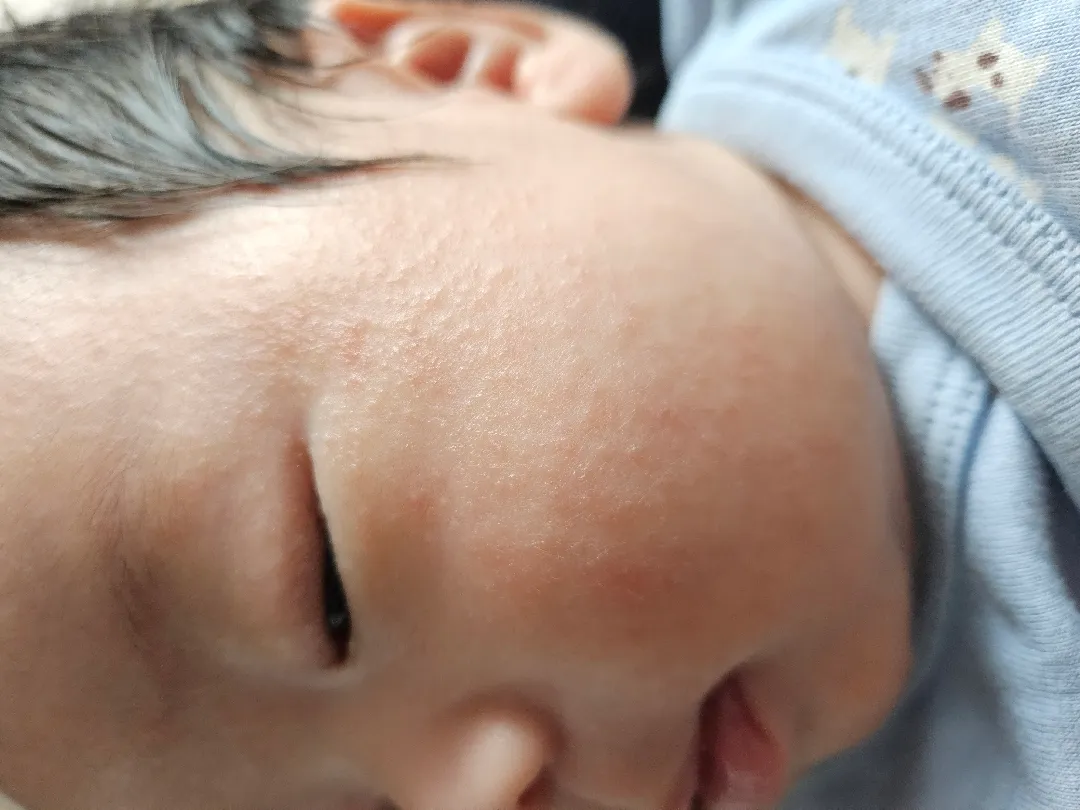 얼굴이 오돌토돌하게 올라와요ㅜㅜ