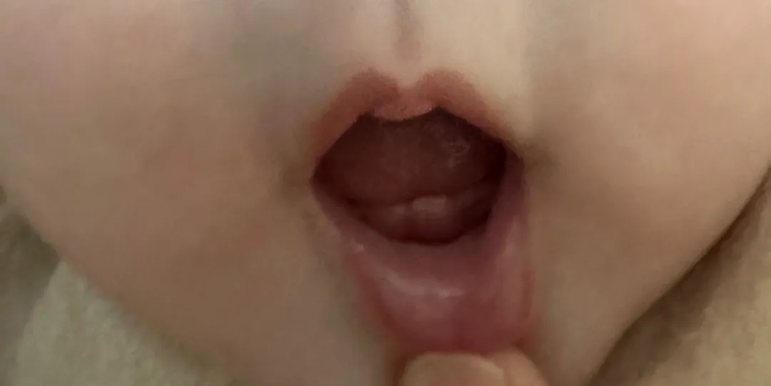 이가났어요🦷🦷