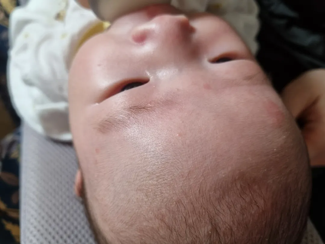 애기 얼굴 뾰루지 ㅠ