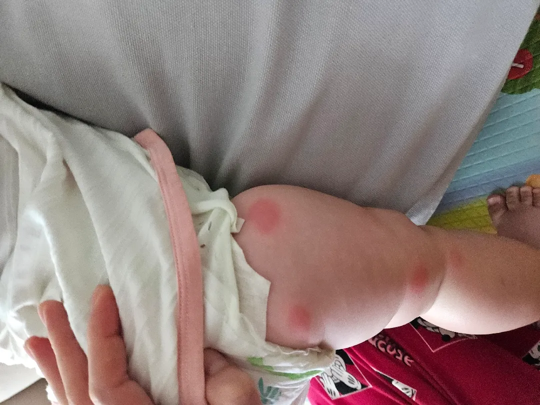 산모기에 물려서 난리에요