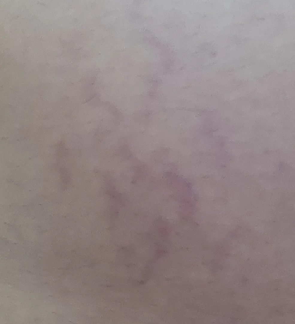 튼살크림 바르면 없어질까요?