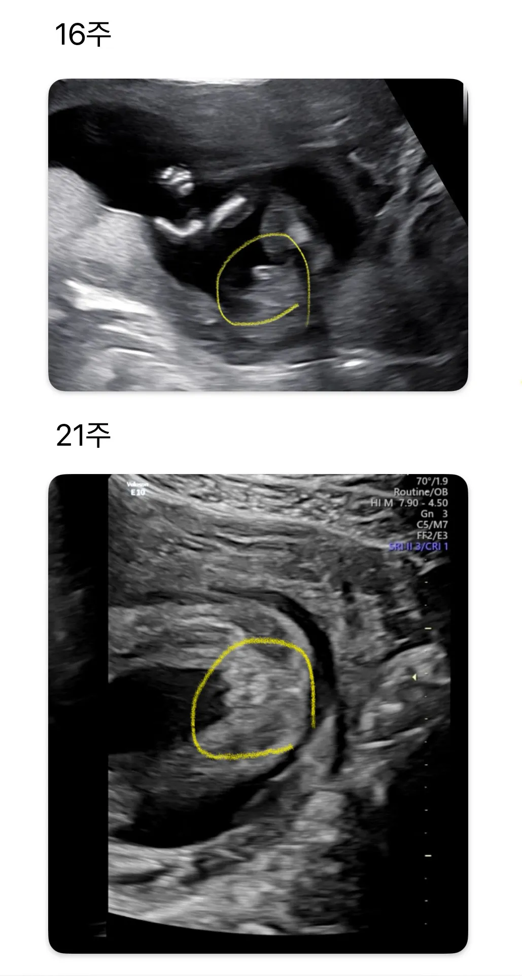 16주 아들 > 21주 딸 촘파 변화사진