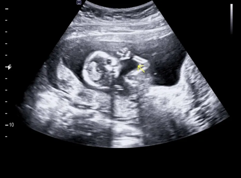 14주3일 성별확정🙂