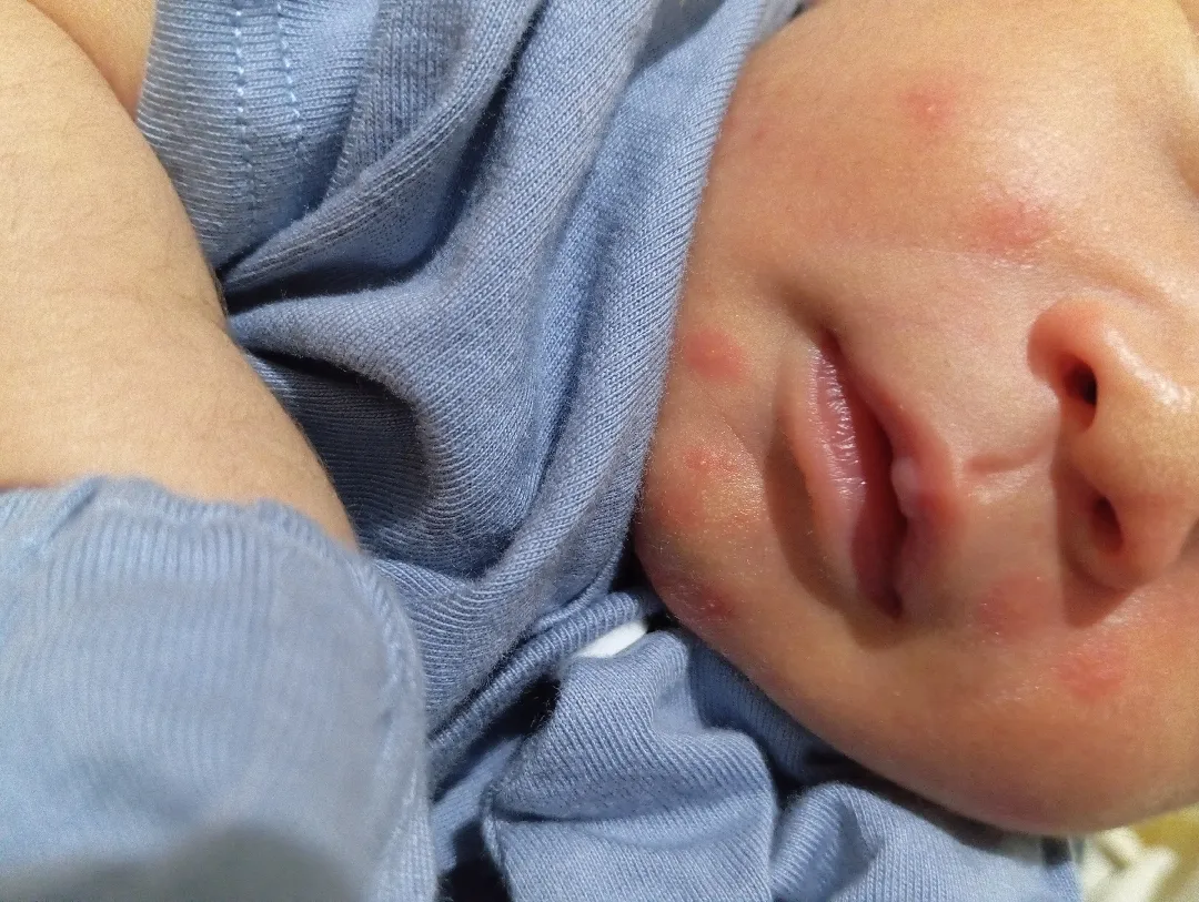Kemerahan pada kulit new born