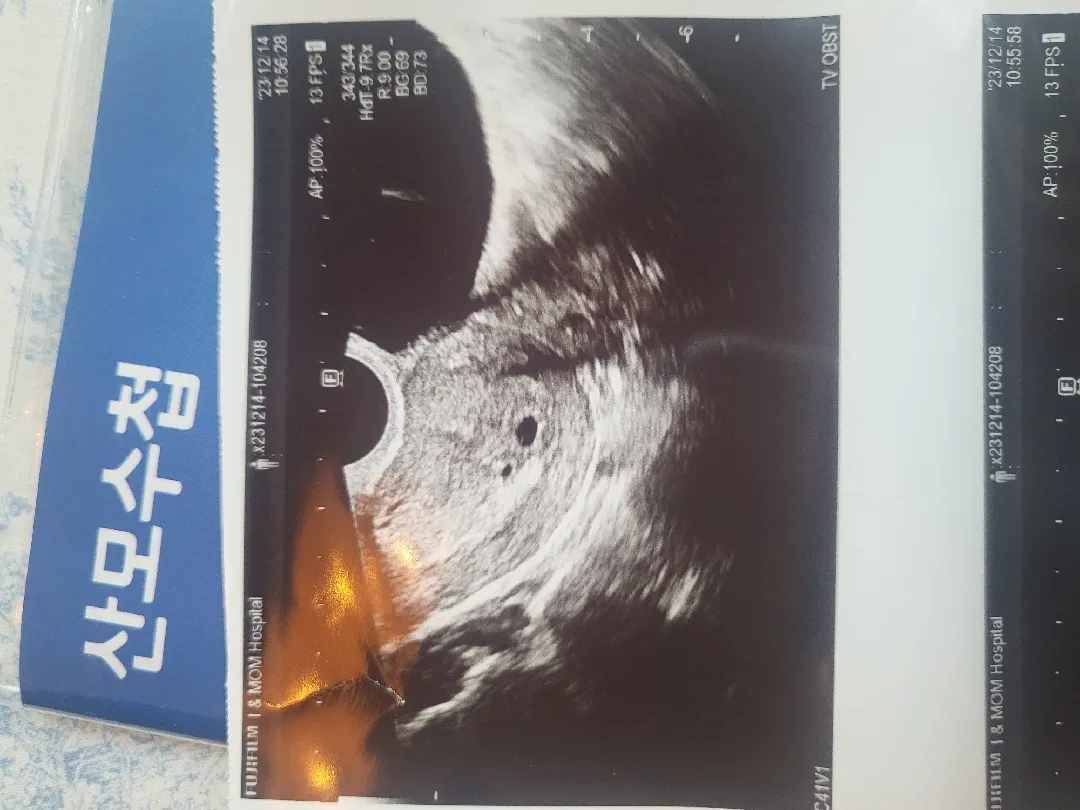 요거 아기집처럼 보이세요..?