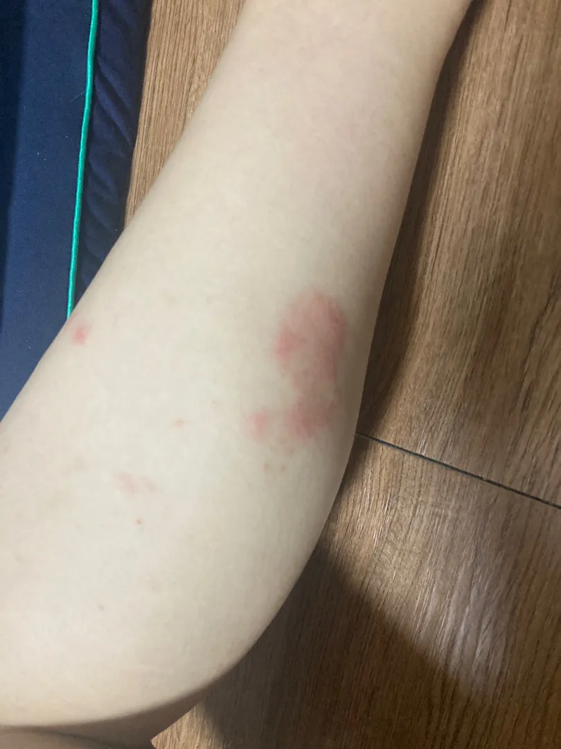 임신 소양증