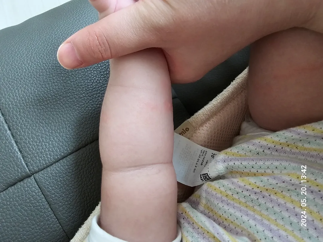 85일아기 피부ㅜㅜ