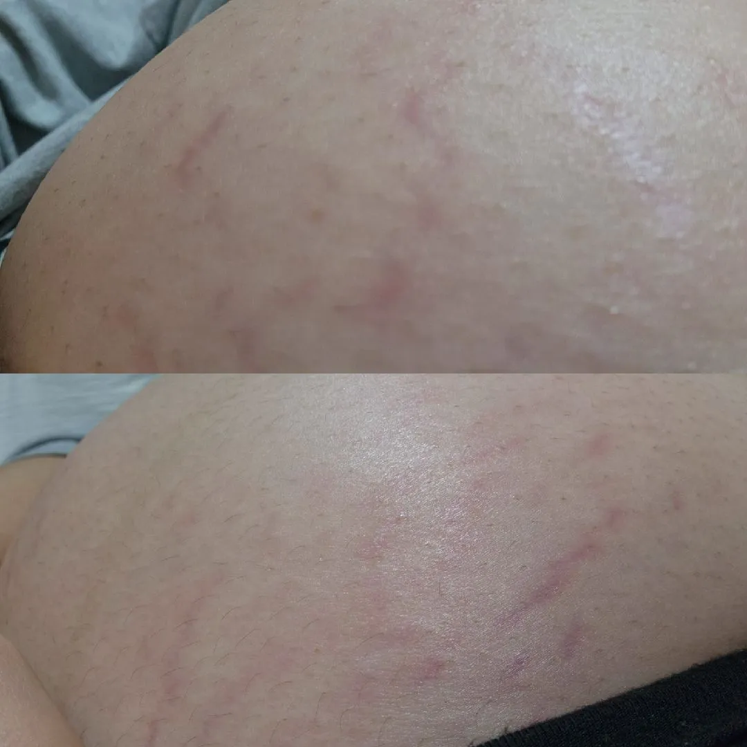 18주3일인데 배꼽아래 튼살..😔