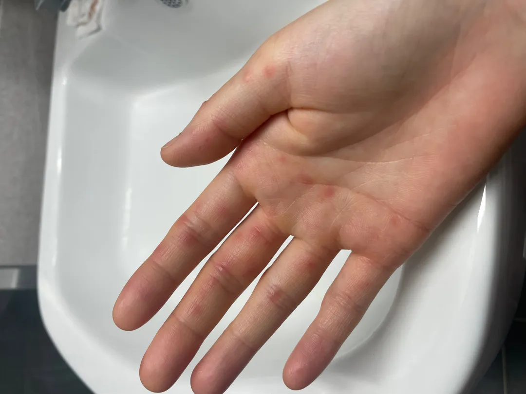 임산부 수족구 걸리신분 계신가요?