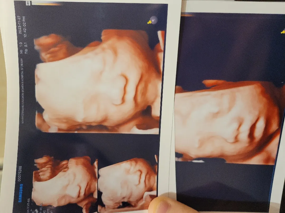 입체초음파