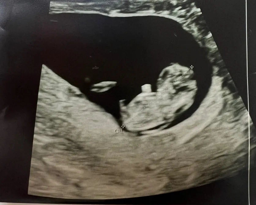 9주 3일차 초음파 보고 왔어요~ 