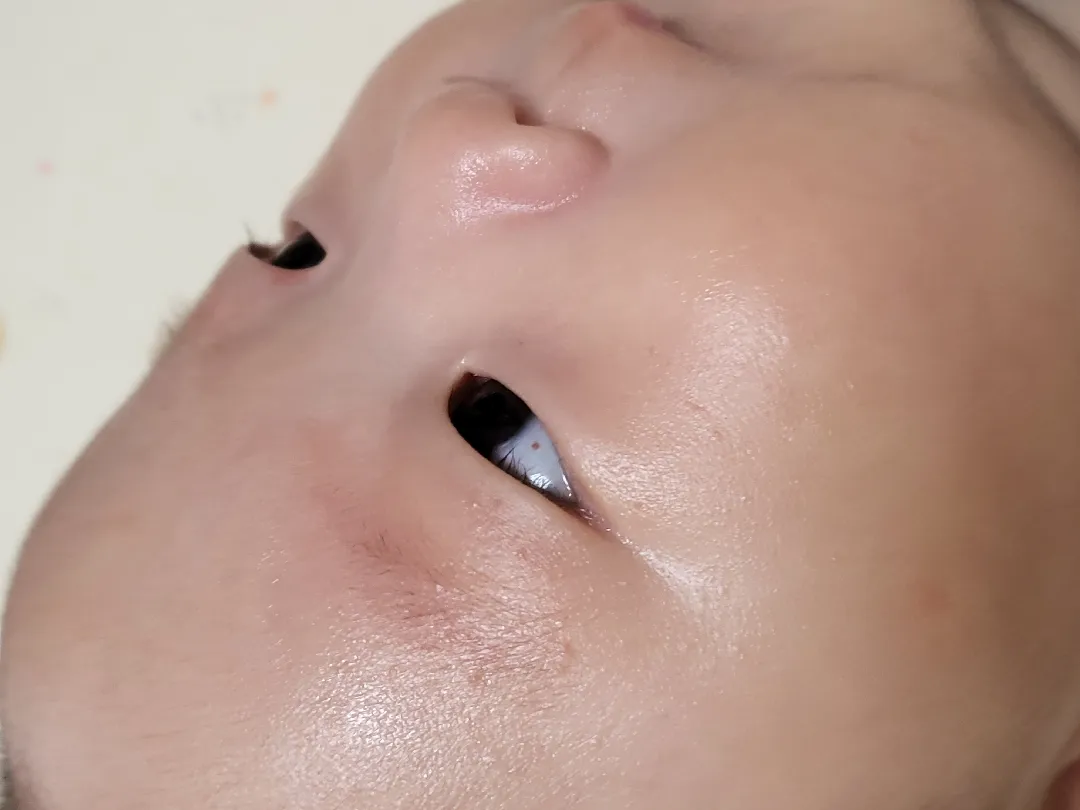 눈안에빨간점