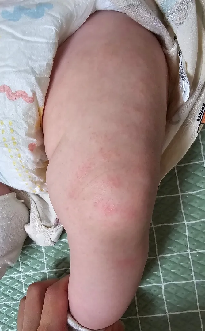 저희아기 피부 봐주세요ㅠㅠ