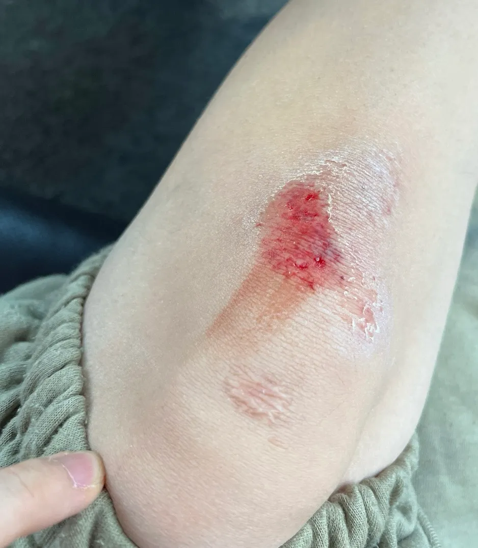 ㅠㅠ애기가 안다치고 이만해서 다행이에요ㅠㅠ(상처사진있어요)