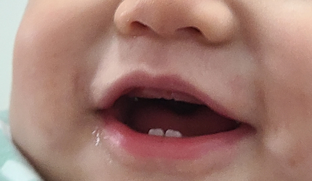 윗니 이갈이ㅠㅠ