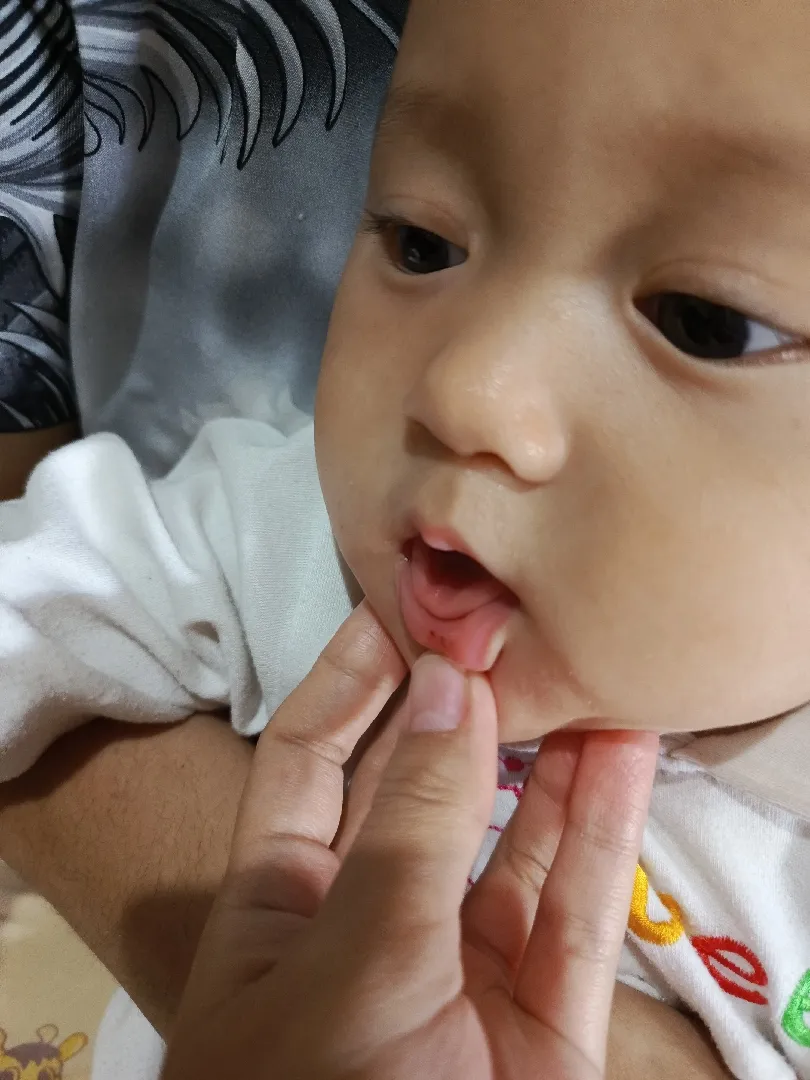 Bibir bintik merah