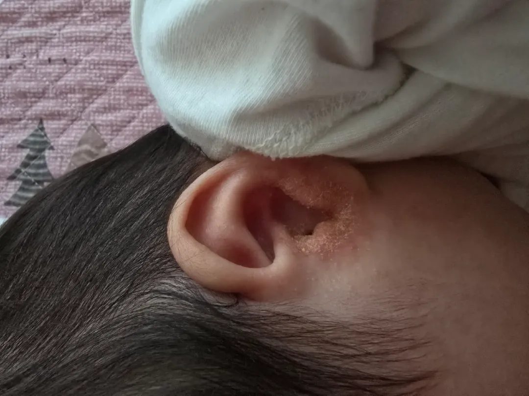 귀 태열로 인한 외이염? 무슨 증상일까요 병원 가야 할까요?