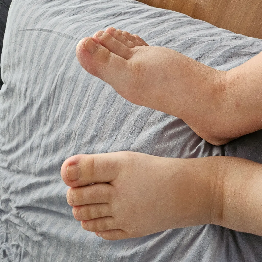 제왕수술 6일차