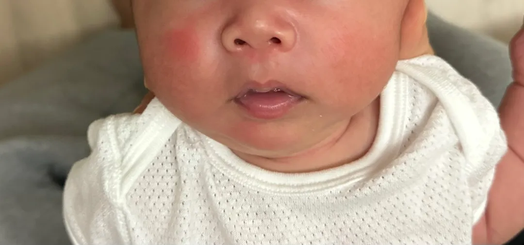 태열?홍조???