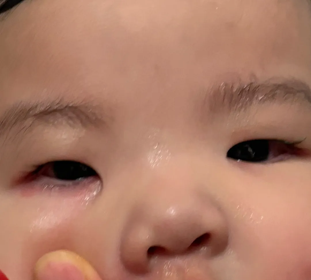 알러지일까요?