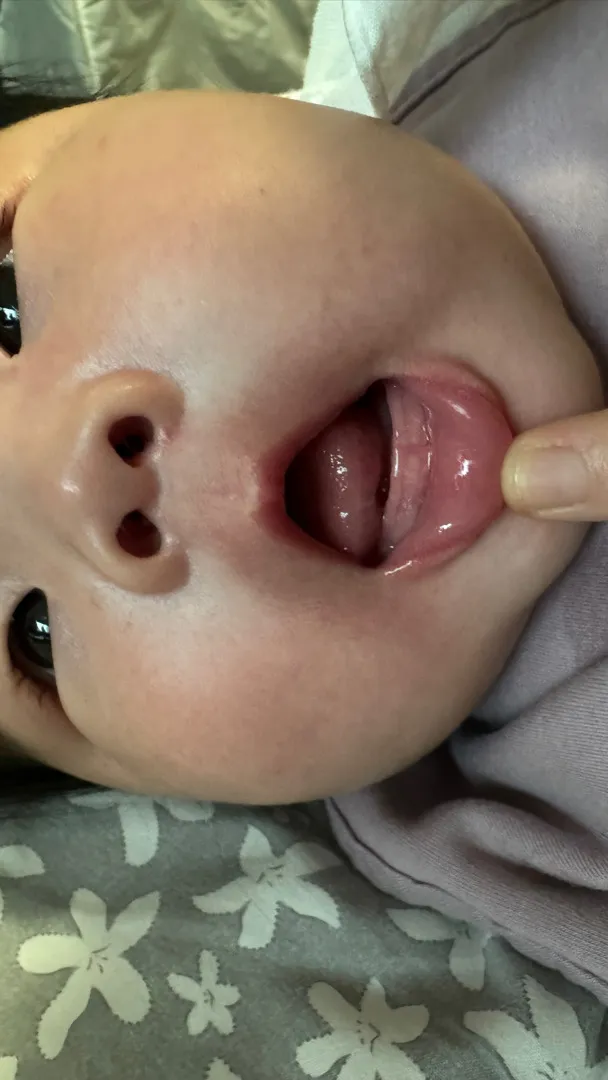 이거 이앓이 일까요? 