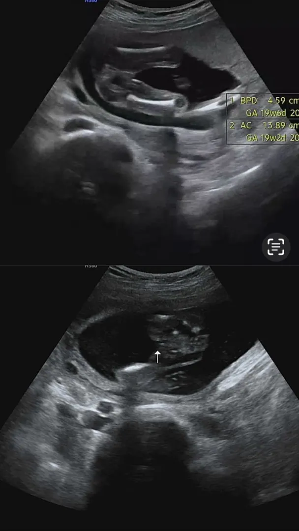 19주 성별반전은 없는거겠죠?!