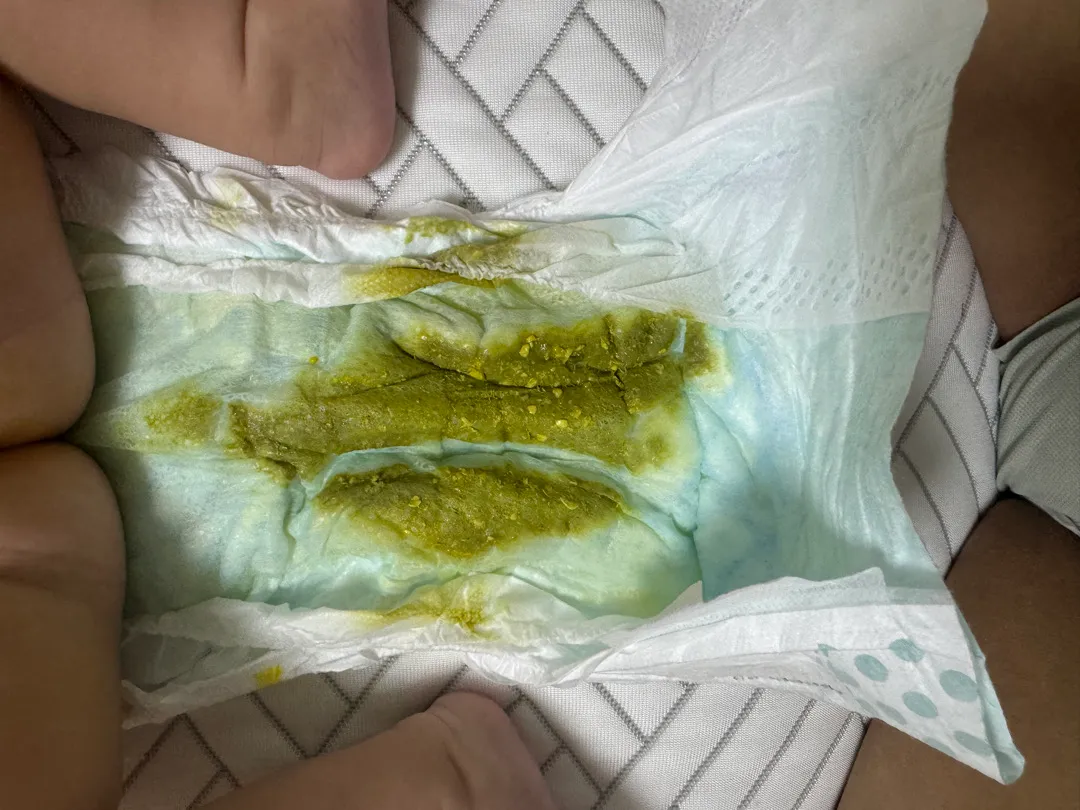 아기가 설사해요 사진주의..