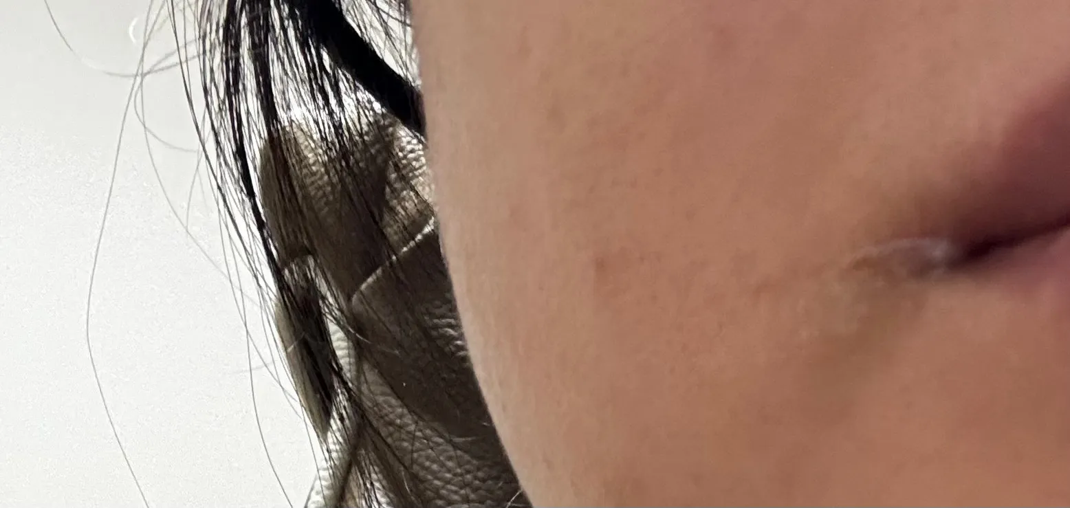 임신26주 양꼬치먹다 얼굴화상 오떠카죠..?