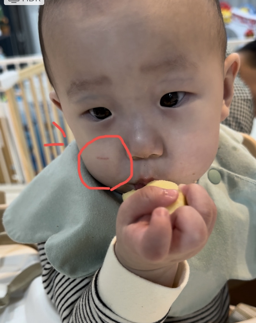 얼굴상처
