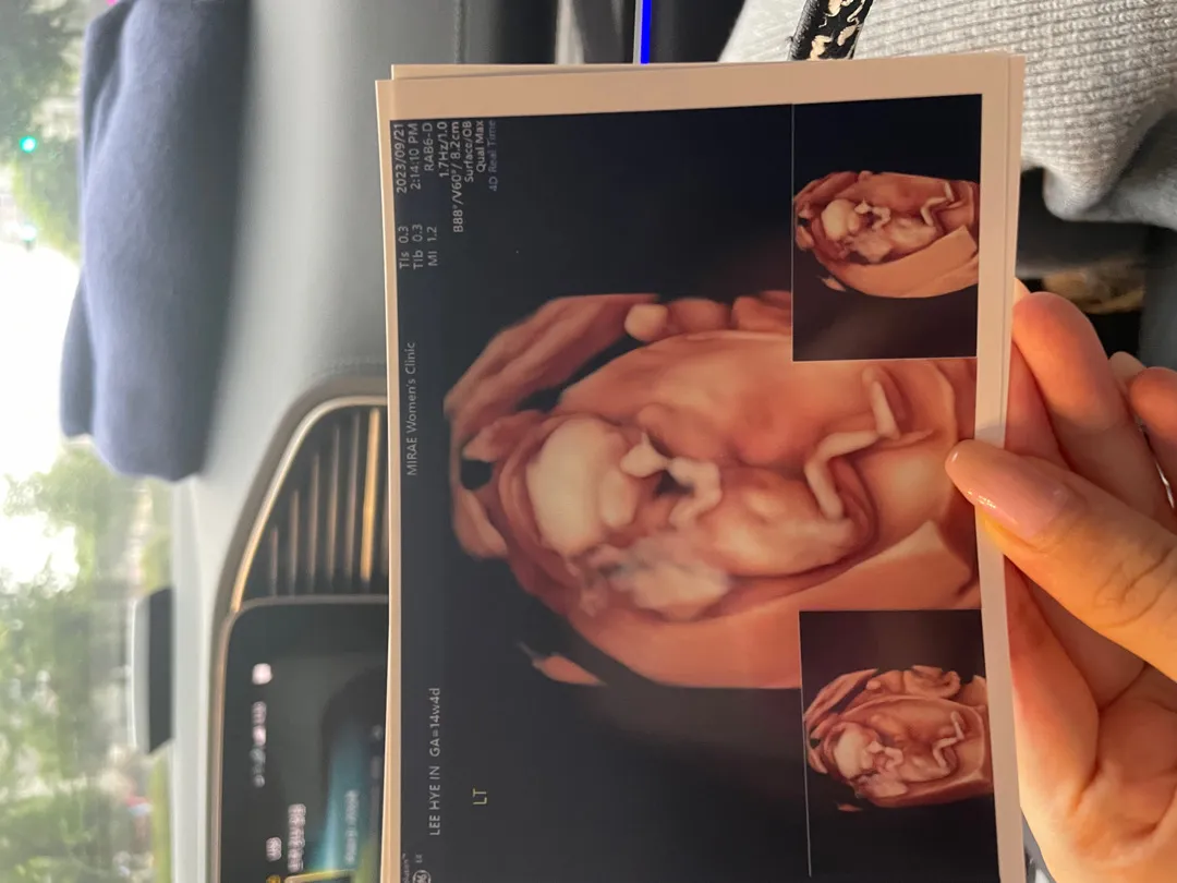 딸일까요 아들일까요~?(입체초음파)