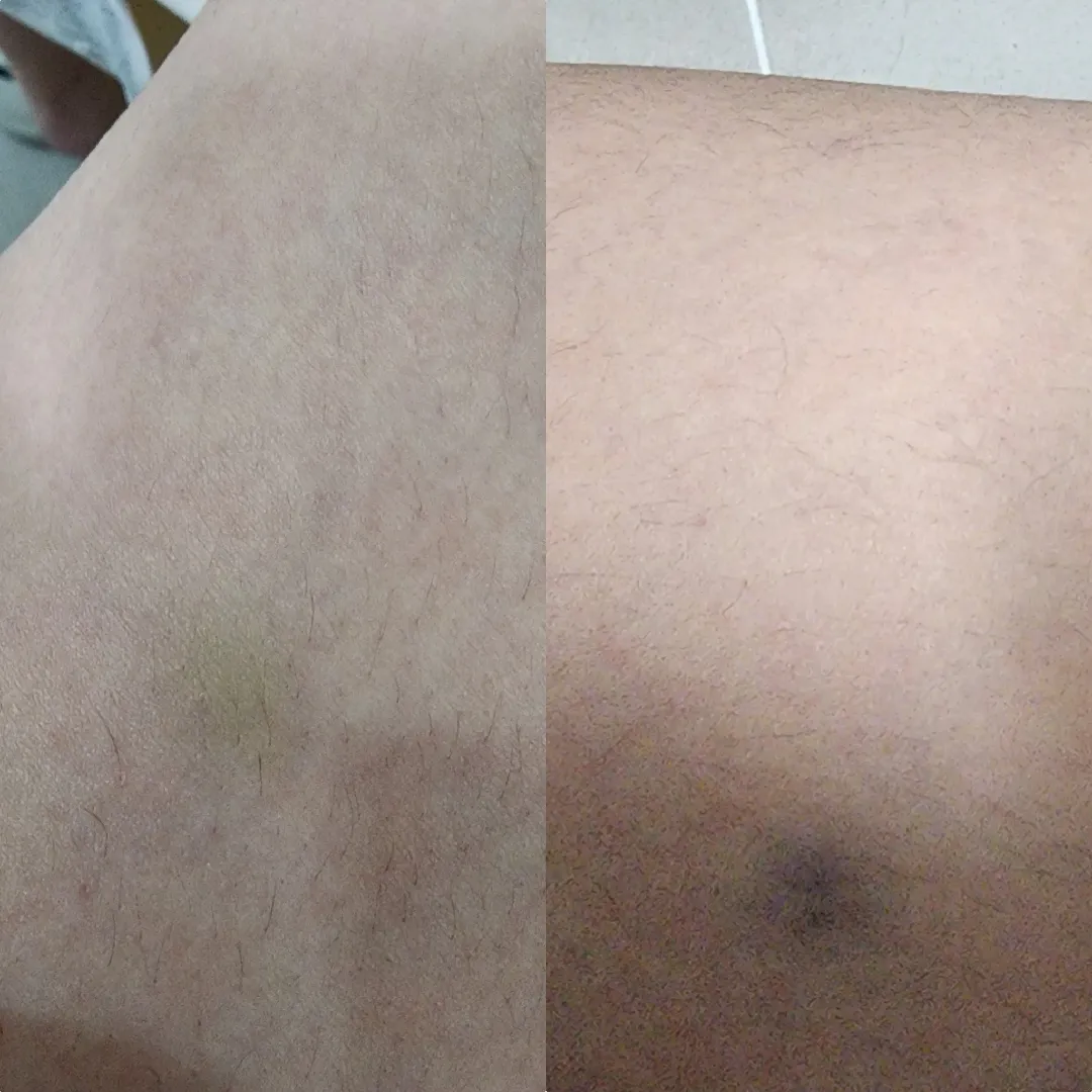 허벅지멍