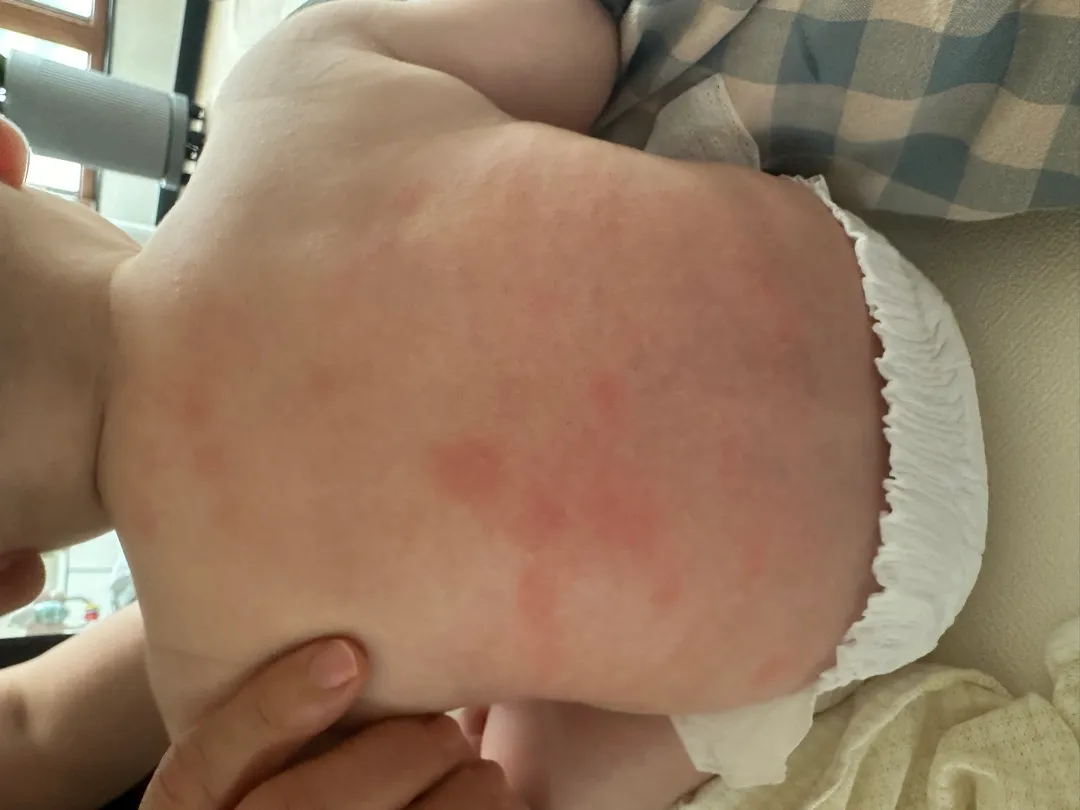아기 몸에 붉은 반점 습진인지 바주세요ㅜㅜ
