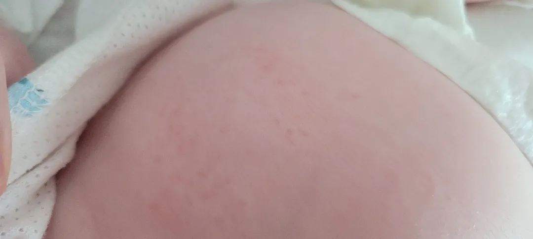 아토피?