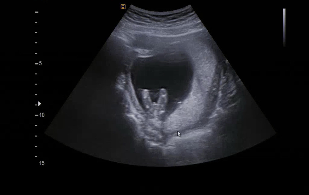 13주3일 아들?딸? 참견해주세요🥹