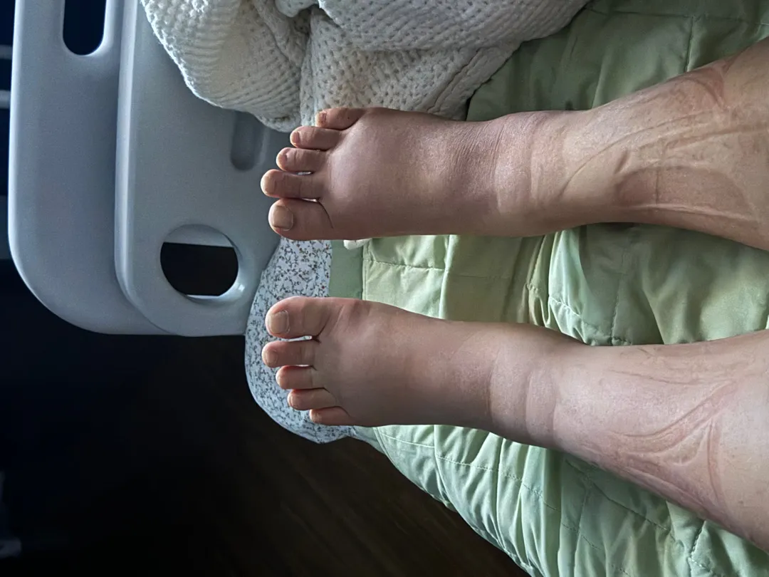 출산후 3일차인데 붓기