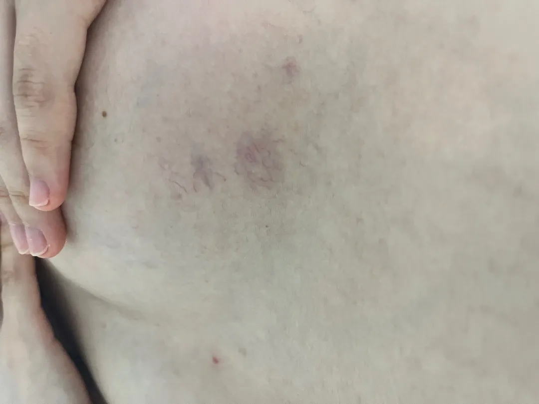 가슴핏줄 …! (사진 있음 주의)