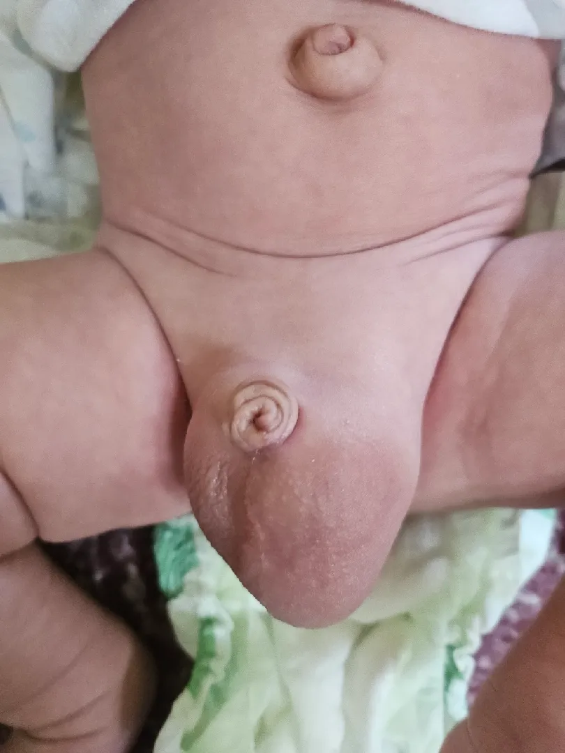 남아 탈장 대해서.....