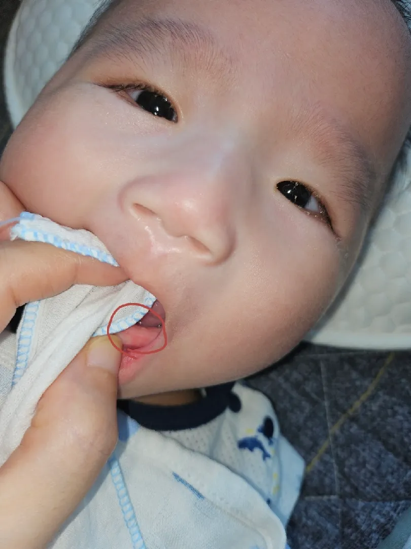 4개월 남아 치아 인지 봐주세요