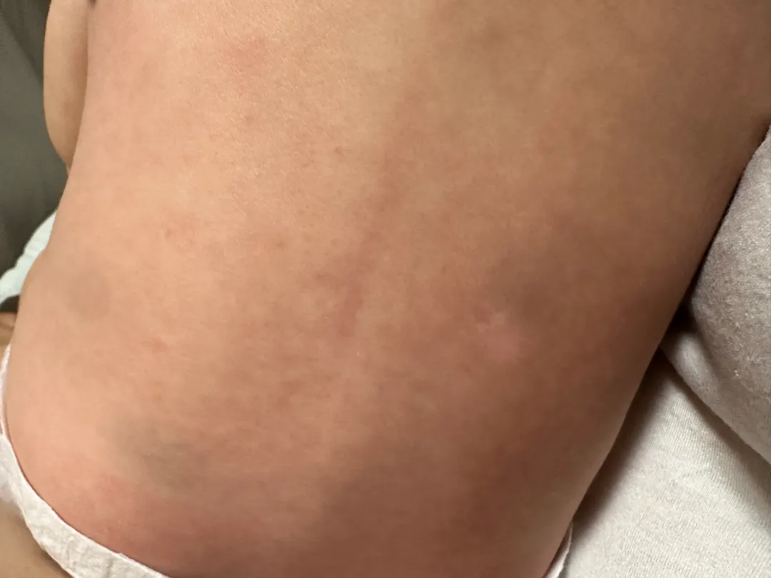 120일 아기 등에 하얀 점!?