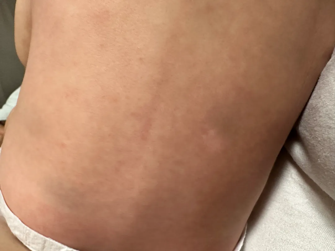 아기 등에 하얀 점