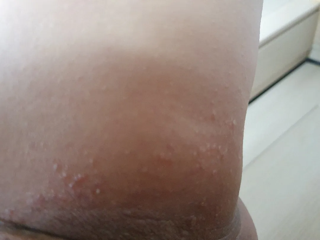 소양증인가요