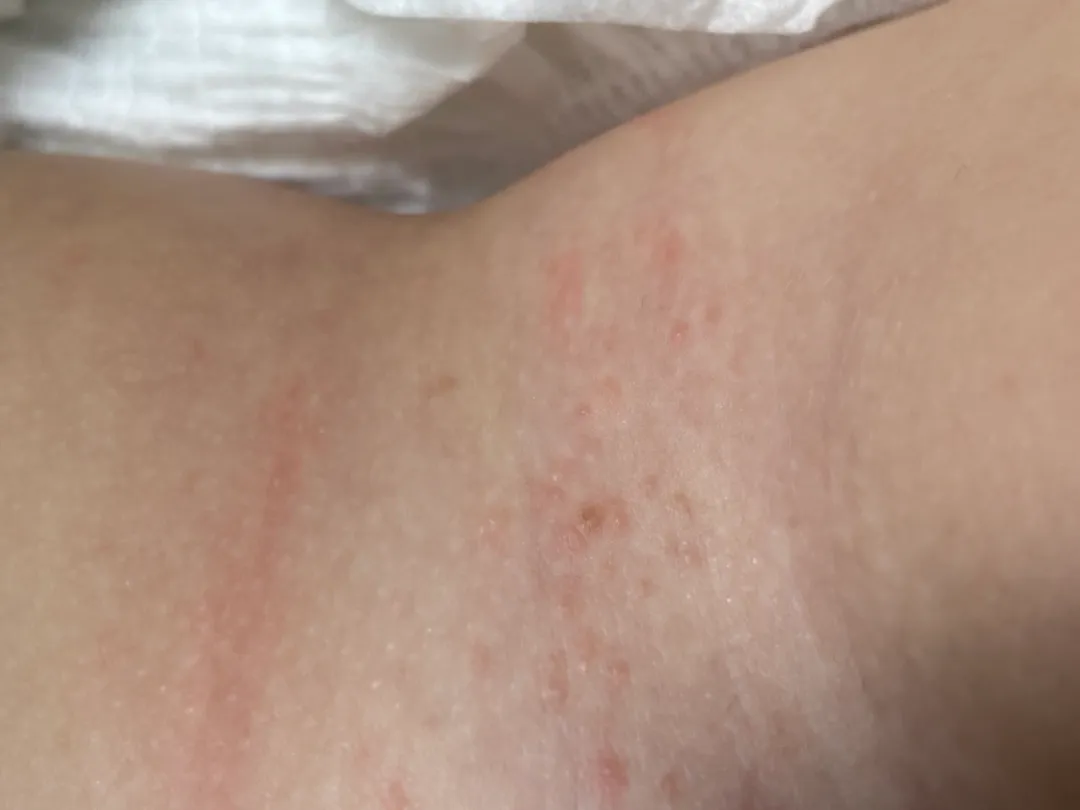 갑자기 물집같은거. 생겻어요 