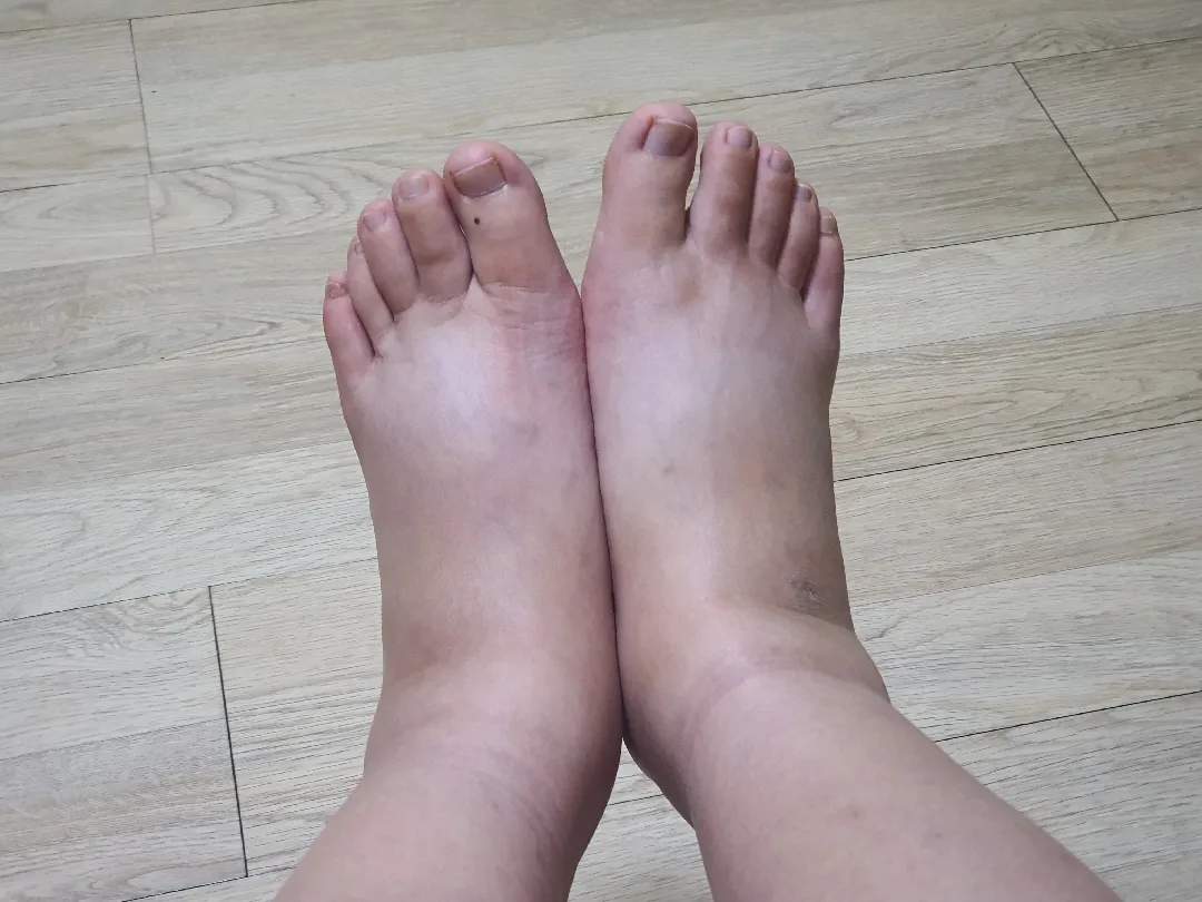 제왕5일째  위가 계속아파요ㅜ