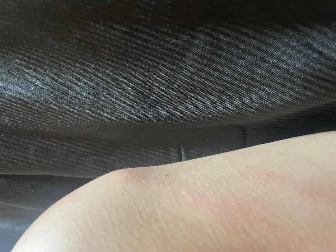 백일해 주사 가렵고 부었어요