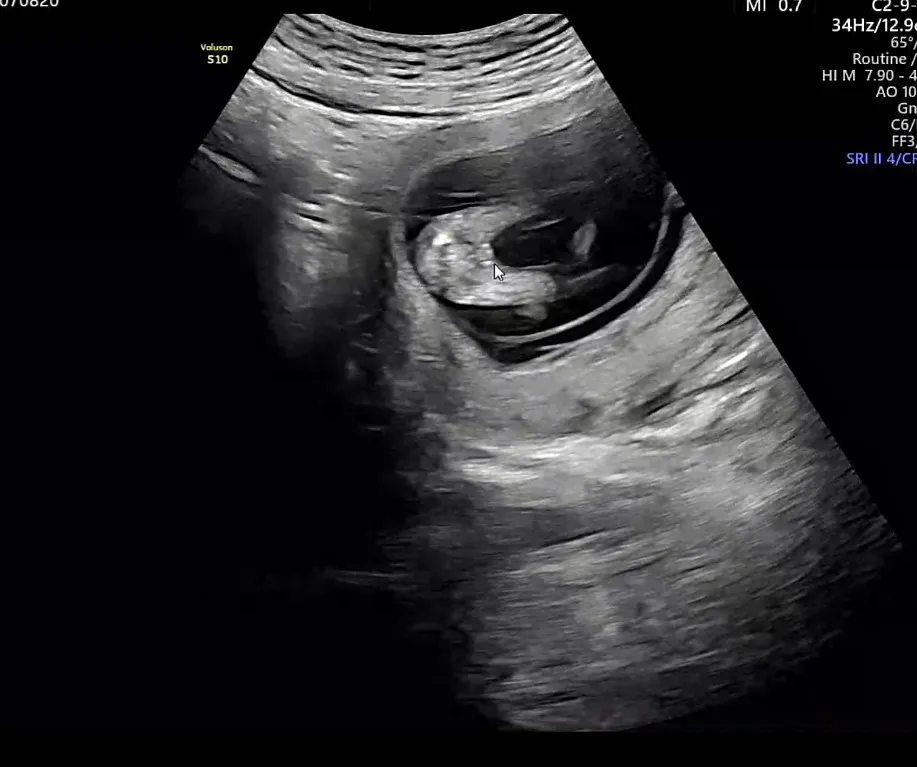 12주5일, 딸일것 같아요!!