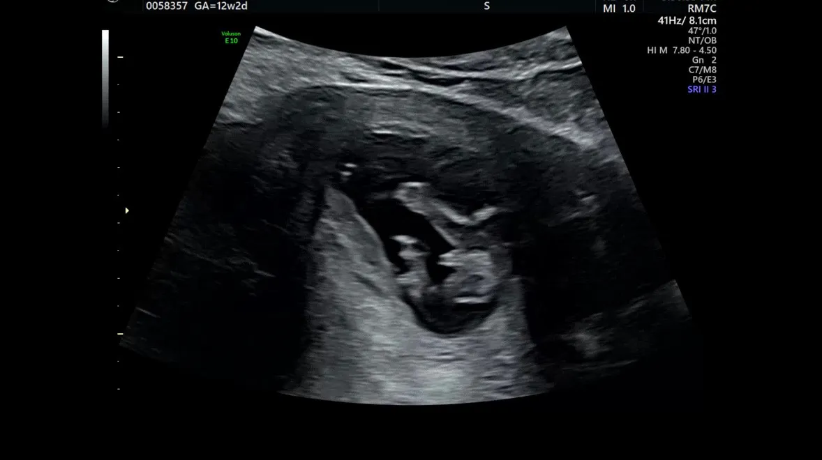 12주 2일♥ 성별 너무 궁금하네요@@
