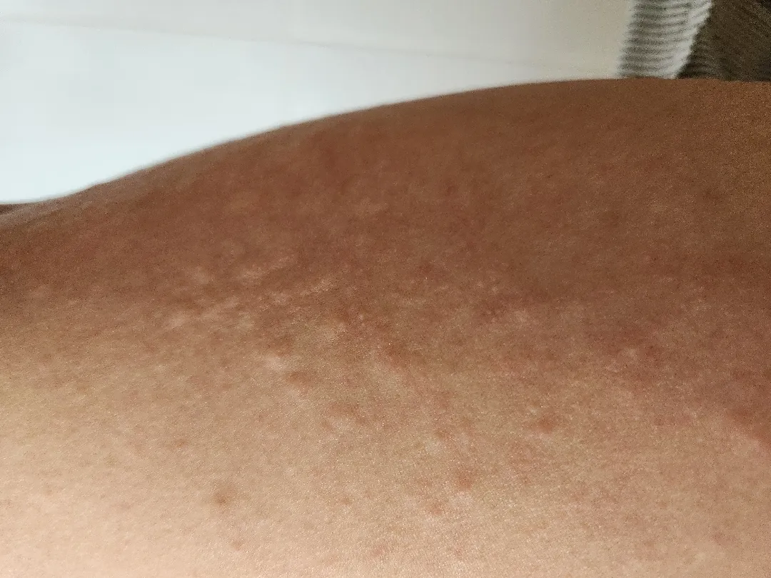 산후소양증??